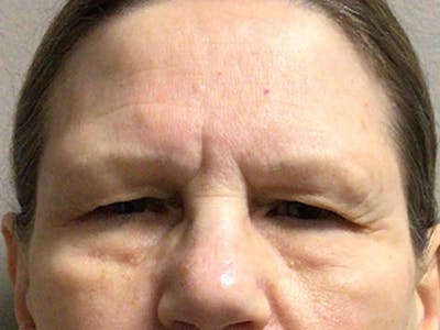 Brow Lift Before & After Gallery - Patient 199783 - Image 1
