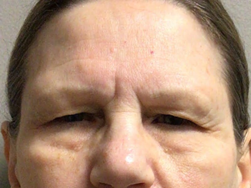 Blepharoplasty Before & After Gallery - Patient 257432 - Image 1