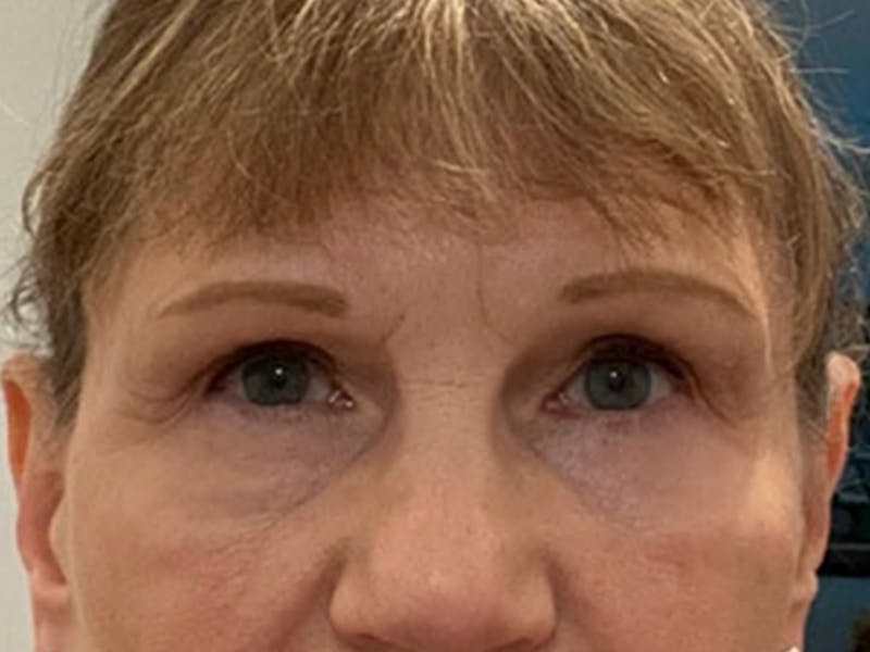 Blepharoplasty Before & After Gallery - Patient 257432 - Image 2