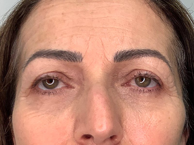 Blepharoplasty Before & After Gallery - Patient 220281 - Image 1