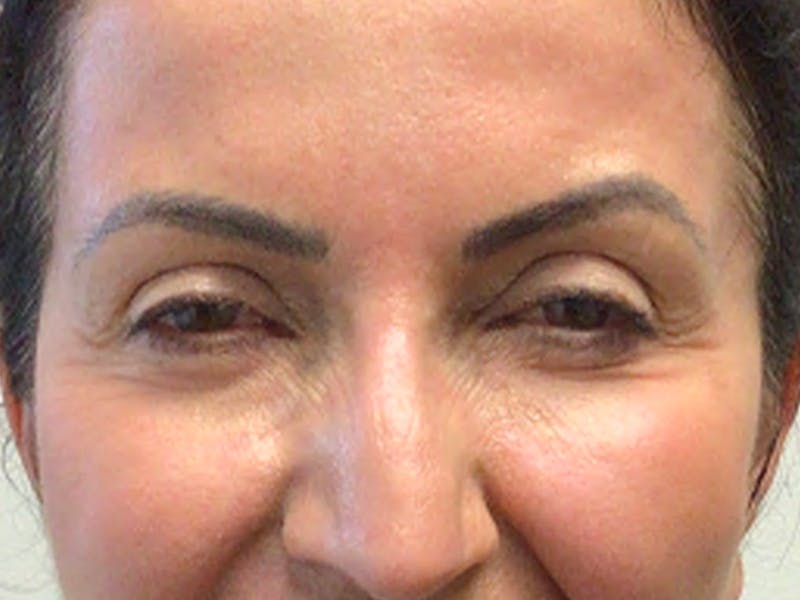 Blepharoplasty Before & After Gallery - Patient 220281 - Image 2