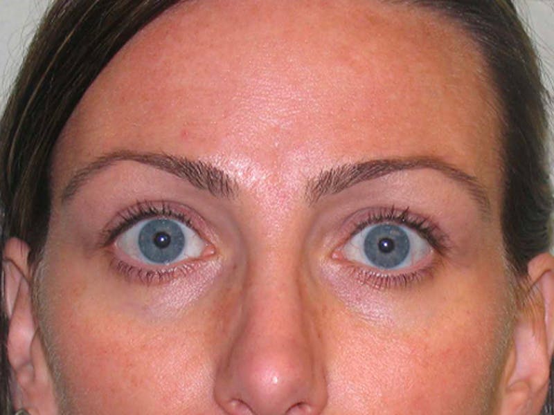Blepharoplasty Before & After Gallery - Patient 369260 - Image 1