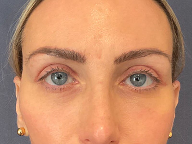Blepharoplasty Before & After Gallery - Patient 369260 - Image 2