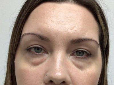 Blepharoplasty Before & After Gallery - Patient 407594 - Image 1