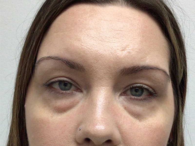 Blepharoplasty Before & After Gallery - Patient 407594 - Image 1
