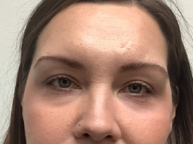 Blepharoplasty Before & After Gallery - Patient 407594 - Image 2
