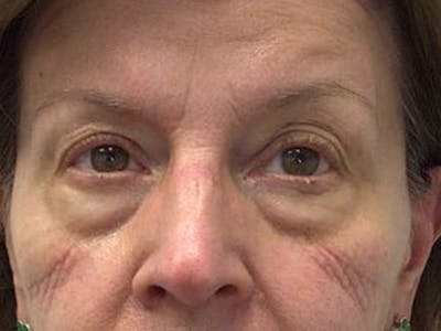 Blepharoplasty Before & After Gallery - Patient 106183 - Image 1