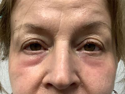 Blepharoplasty Before & After Gallery - Patient 106183 - Image 2