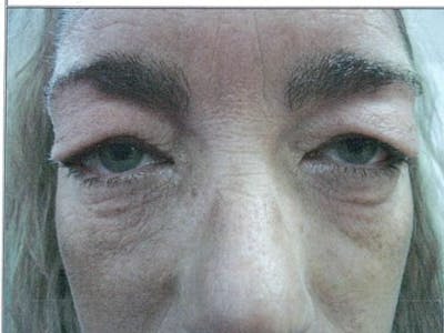 Blepharoplasty Before & After Gallery - Patient 837509 - Image 1