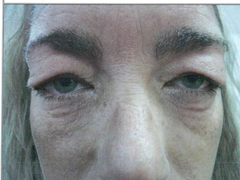 Blepharoplasty Before & After Gallery - Patient 837509 - Image 1