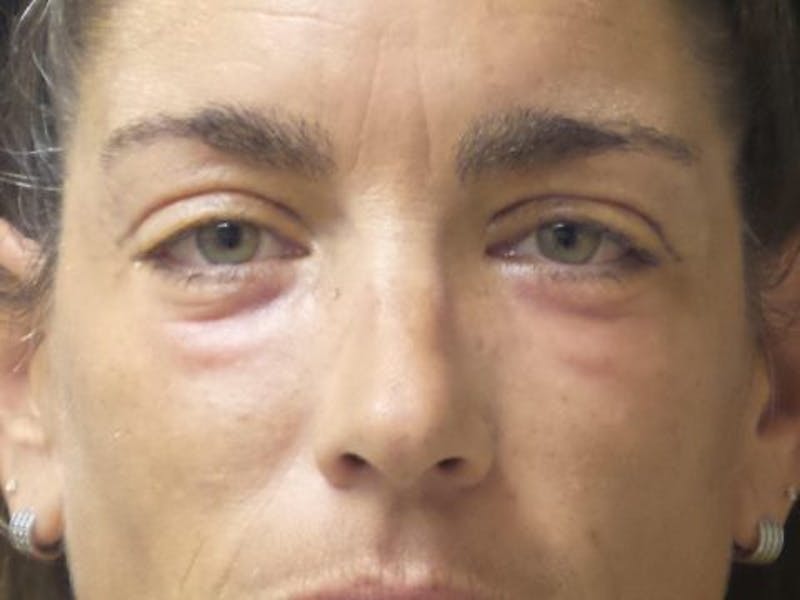 Blepharoplasty Before & After Gallery - Patient 837509 - Image 2