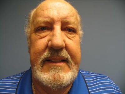 Blepharoplasty Before & After Gallery - Patient 176111 - Image 1