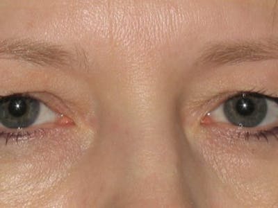 Blepharoplasty Before & After Gallery - Patient 139094 - Image 1