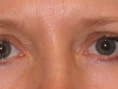 Blepharoplasty Before & After Gallery - Patient 139094 - Image 2