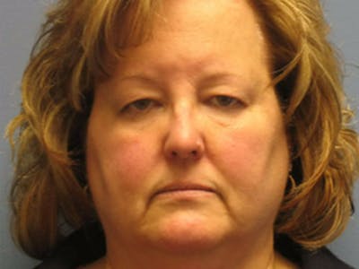 Blepharoplasty Before & After Gallery - Patient 322601 - Image 1