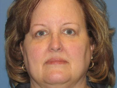 Blepharoplasty Before & After Gallery - Patient 322601 - Image 2
