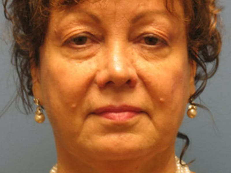 Blepharoplasty Before & After Gallery - Patient 569869 - Image 1