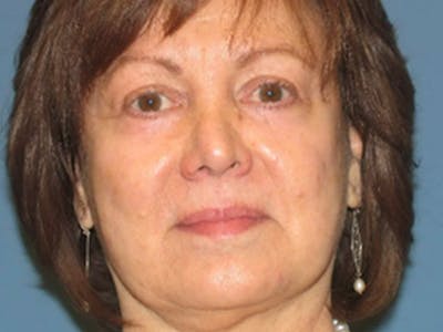 Blepharoplasty Before & After Gallery - Patient 569869 - Image 2