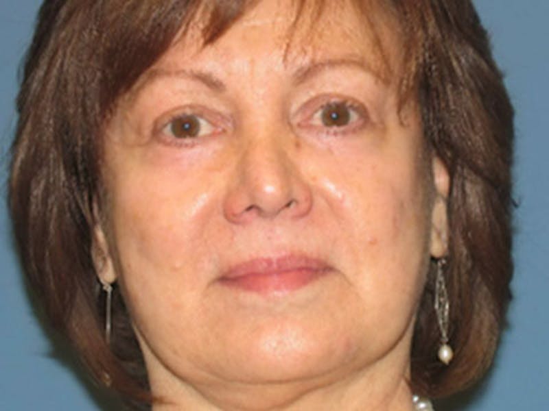 Blepharoplasty Before & After Gallery - Patient 569869 - Image 2