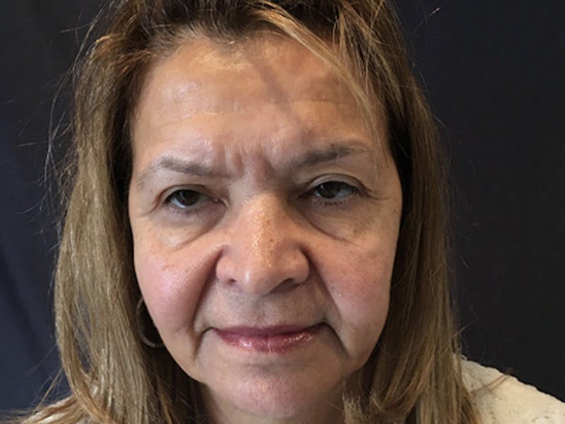 Blepharoplasty Before & After Gallery - Patient 317284 - Image 1