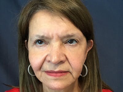Blepharoplasty Before & After Gallery - Patient 317284 - Image 2