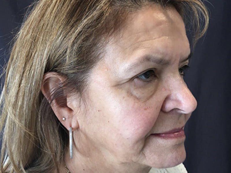 Blepharoplasty Before & After Gallery - Patient 317284 - Image 3