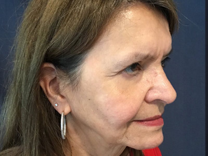 Blepharoplasty Before & After Gallery - Patient 317284 - Image 4