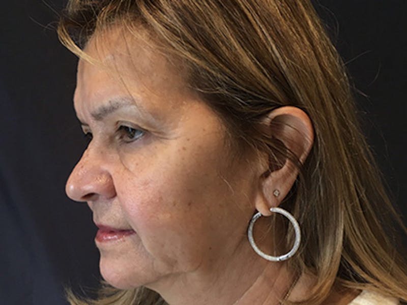 Blepharoplasty Before & After Gallery - Patient 317284 - Image 5