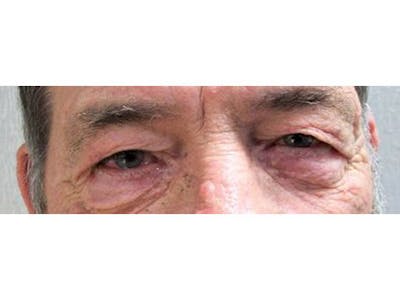 Blepharoplasty Before & After Gallery - Patient 332817 - Image 1