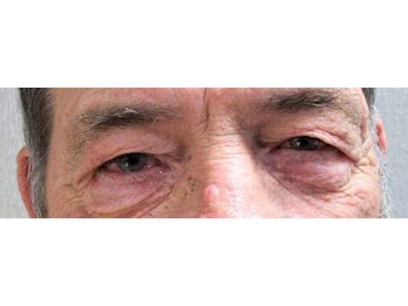 Blepharoplasty Before & After Gallery - Patient 332817 - Image 1