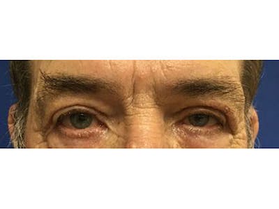 Blepharoplasty Before & After Gallery - Patient 332817 - Image 2