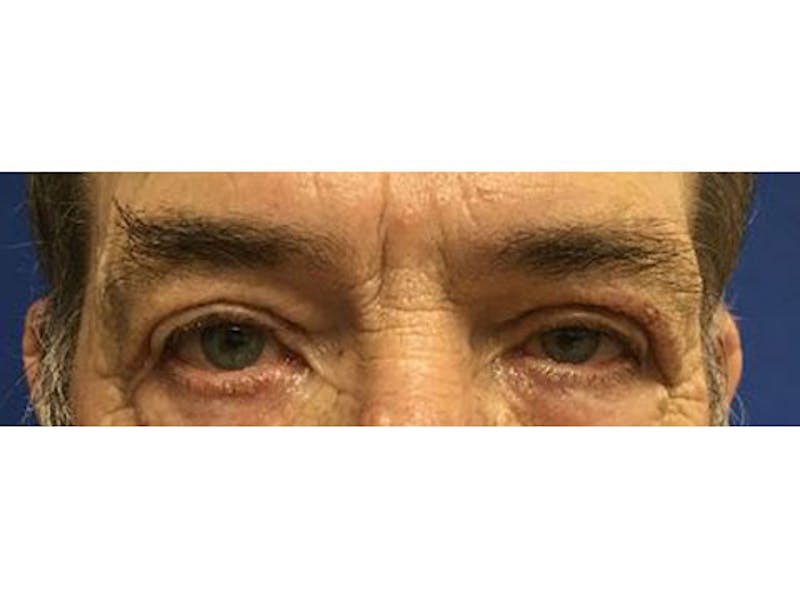 Blepharoplasty Before & After Gallery - Patient 332817 - Image 2