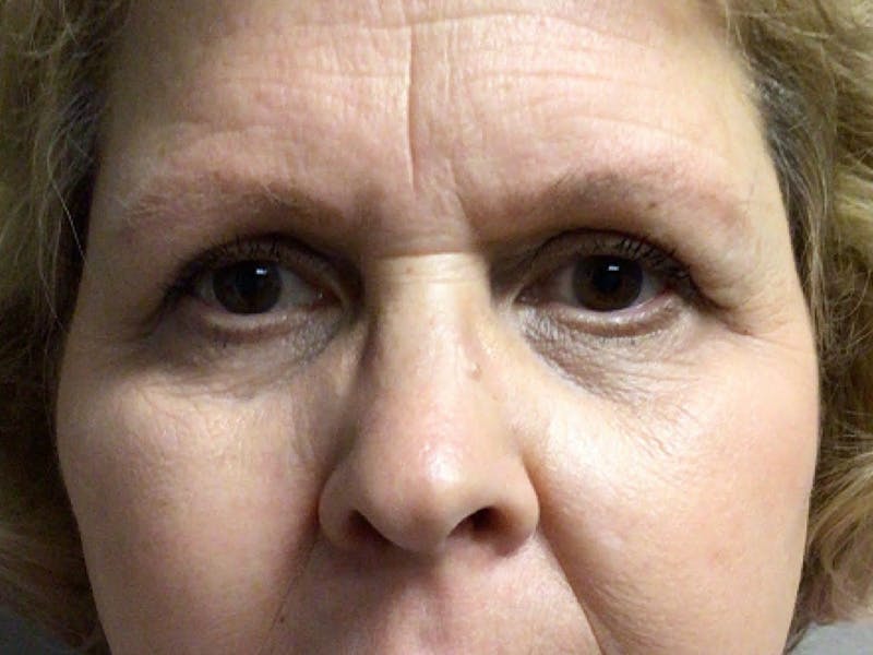 Brow Lift Before & After Gallery - Patient 150123 - Image 1