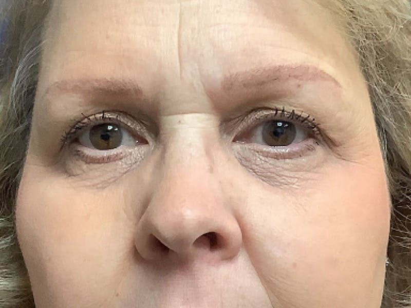 Brow Lift Before & After Gallery - Patient 150123 - Image 2