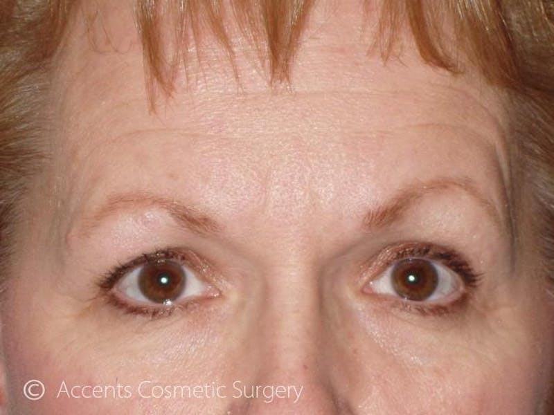 Brow Lift Before & After Gallery - Patient 911115 - Image 1