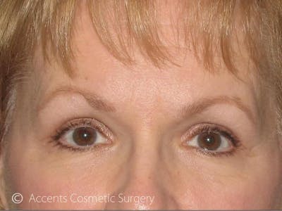 Brow Lift Before & After Gallery - Patient 911115 - Image 2