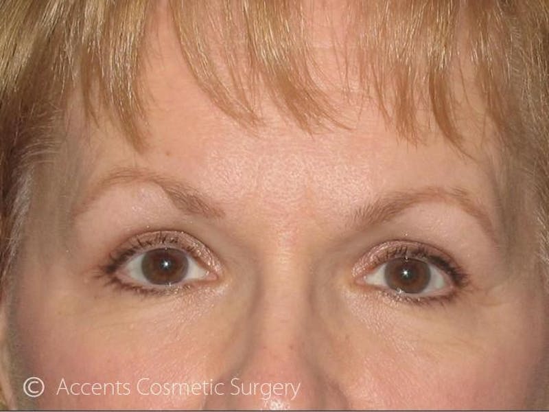 Brow Lift Before & After Gallery - Patient 911115 - Image 2