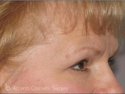 Brow Lift Before & After Gallery - Patient 795343 - Image 1