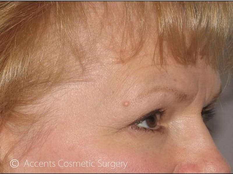 Brow Lift Before & After Gallery - Patient 795343 - Image 1