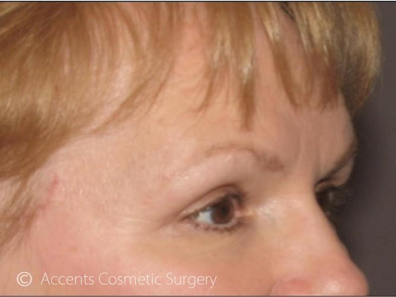 Brow Lift Before & After Gallery - Patient 795343 - Image 2