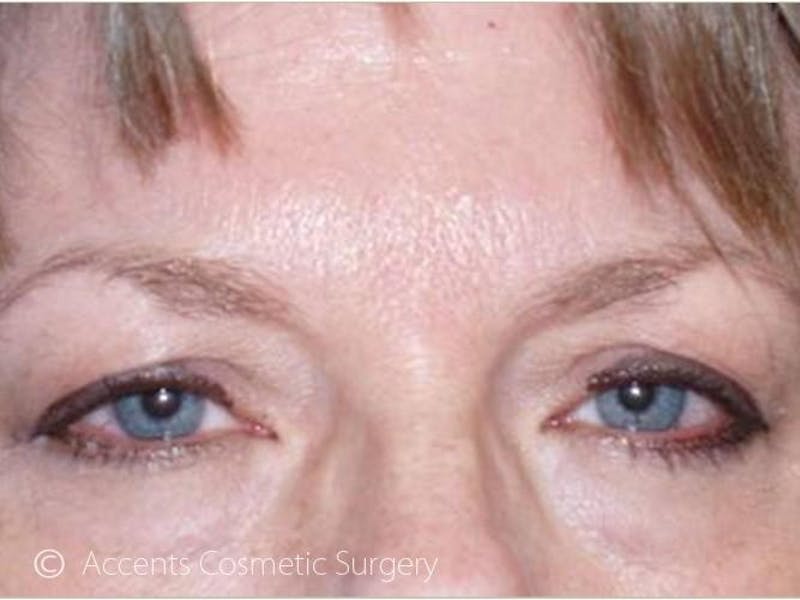 Brow Lift Before & After Gallery - Patient 243830 - Image 1
