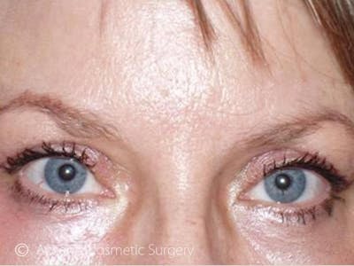 Brow Lift Before & After Gallery - Patient 243830 - Image 2