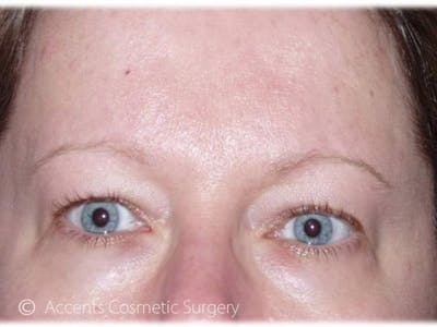 Brow Lift Before & After Gallery - Patient 492336 - Image 1
