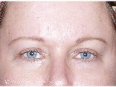 Brow Lift Before & After Gallery - Patient 492336 - Image 2