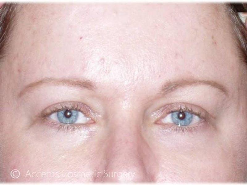 Brow Lift Before & After Gallery - Patient 492336 - Image 2