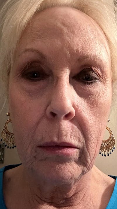 QuickLift Before & After Gallery - Patient 281357 - Image 1