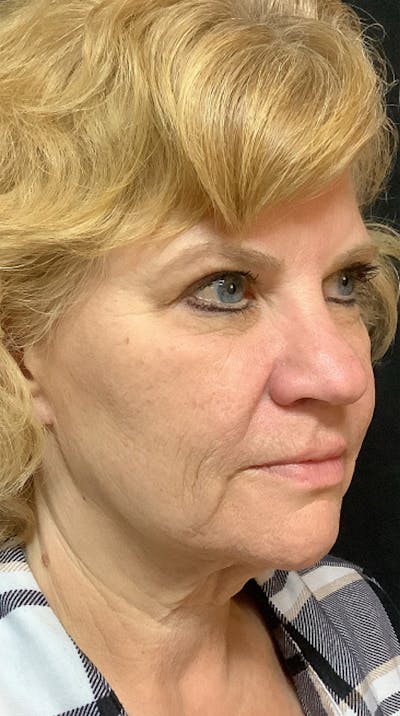 QuickLift Before & After Gallery - Patient 175089 - Image 1