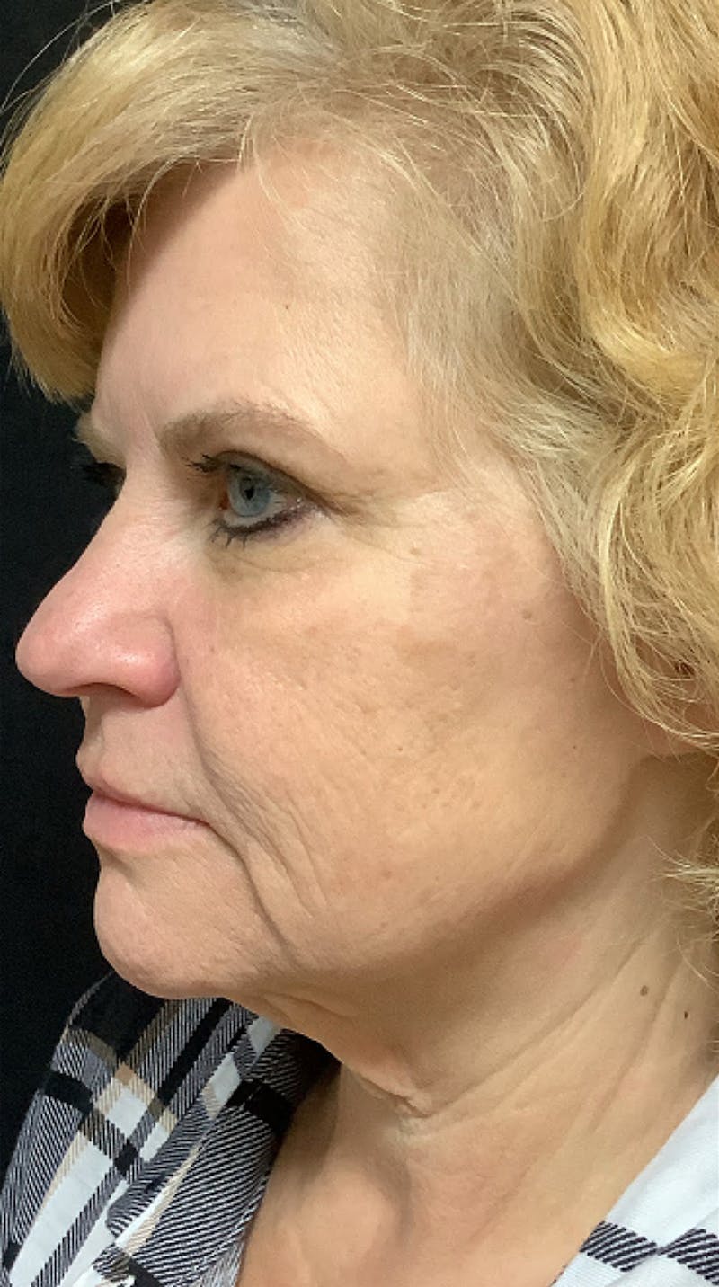 QuickLift Before & After Gallery - Patient 175089 - Image 3