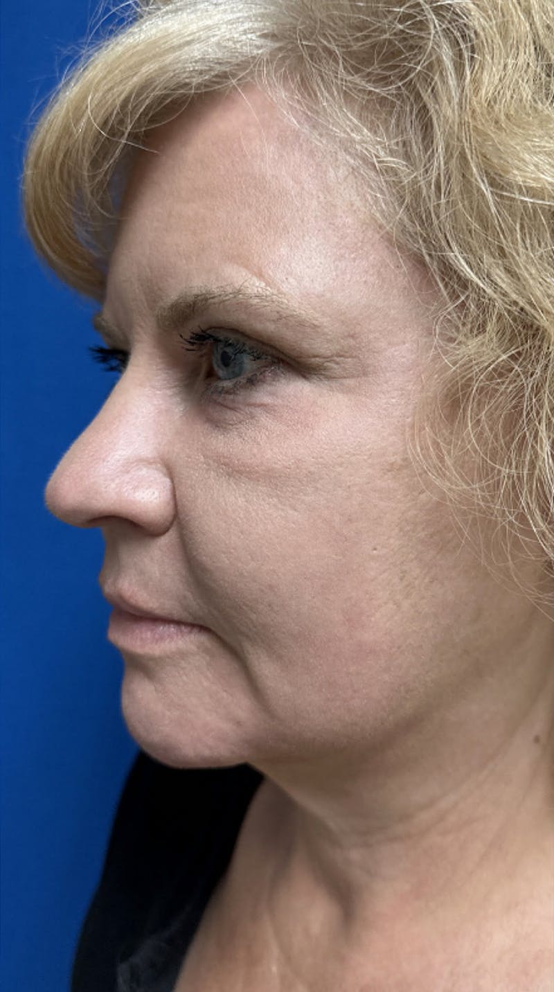 QuickLift Before & After Gallery - Patient 175089 - Image 4