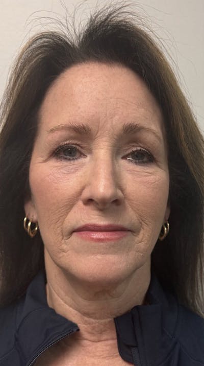 QuickLift Before & After Gallery - Patient 367521 - Image 1